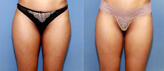 liposuction of saddlebags and thighs for an athletic woman